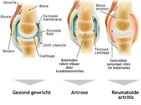 artrose